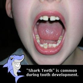 Child with shark teeth