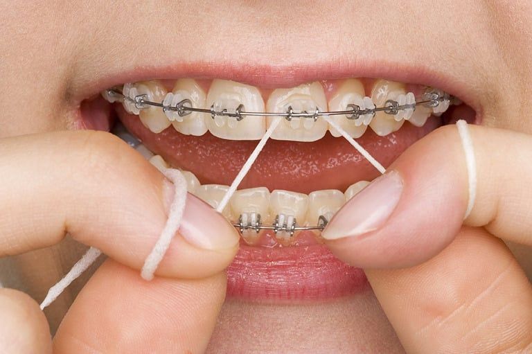 Flossing With Orthodontics