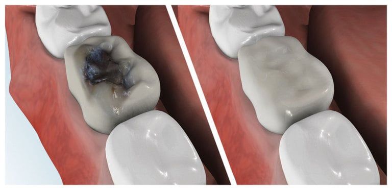 Composite Fillings or Tooth Colored Fillings