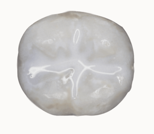 Tooth Molar With Dental Sealants