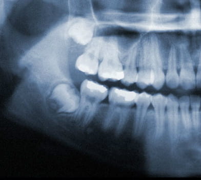 X-Ray of wisdom teeth